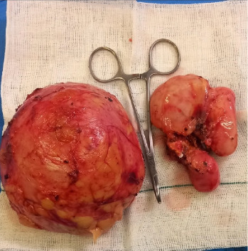 Synchronous Ipsilateral Adrenal and Retroperitoneal Ganglioneuroma: A Unique Case of Large Tumor Mass.