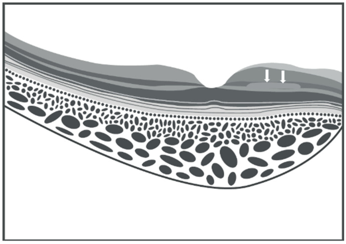 Paracentral Acute Middle Maculopathy (PAMM) in Ocular Vascular Diseases-What We Know and Future Perspectives.