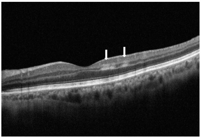 Paracentral Acute Middle Maculopathy (PAMM) in Ocular Vascular Diseases-What We Know and Future Perspectives.
