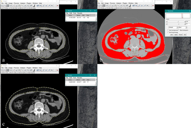 Intermuscular adipose tissue affected muscle density more than intramuscular adipose tissue content with opportunistic screening at abdominal CT.