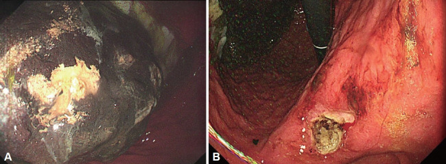 Treatment of a Large Gastric Phytobezoar With Coca-Cola, Cellulase, and Endoscopic Fragmentation in a Community Hospital.