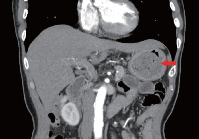 Treatment of a Large Gastric Phytobezoar With Coca-Cola, Cellulase, and Endoscopic Fragmentation in a Community Hospital.