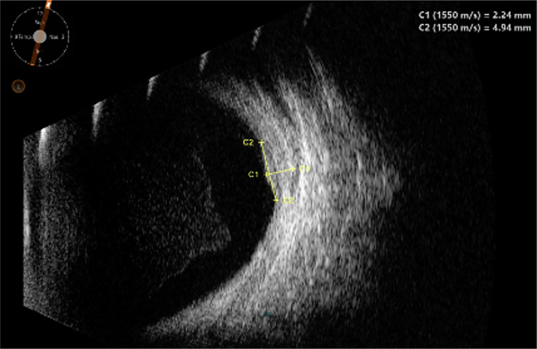 Bilateral Vasoproliferative Tumors in Usher Syndrome.