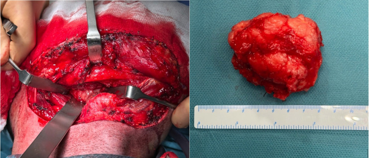 Computer-Aided excision of Parapharyngeal Space Pleomorphic Adenoma by Transcervical Approach. Case report.