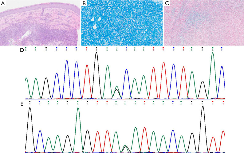 Two missense mutations in Dystonin lead to epidermolysis bullosa simplex complicated with lepromatous leprosy: a case report.