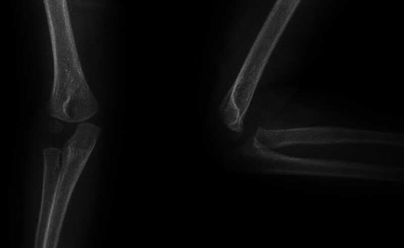 Comparison of radiological, clinical, and functional results of Jakob type 2 lateral condyle fractures treated with closed reduction and percutaneous pinning versus open reduction and K-wire fixation.