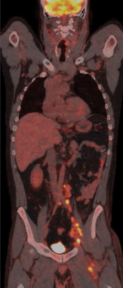 Kaposi Sarcoma: Almost Forgotten but Occasionally There.