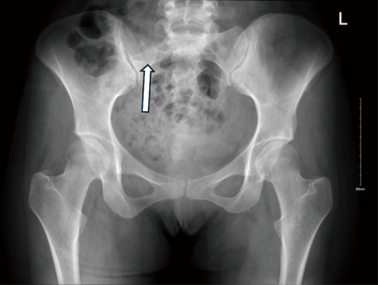 A 3D navigation-guided surgical resection of a rare case of sacral spine mesenchymal chondrosarcoma: a case report.