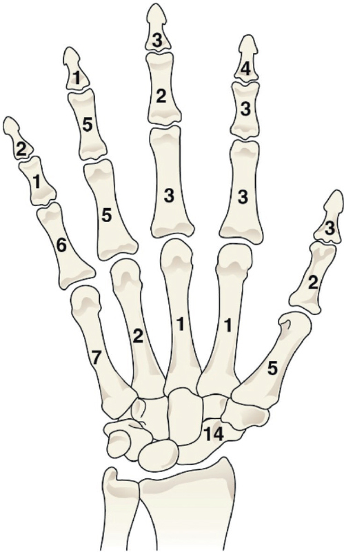 Avoidable injuries in pediatric hand fractures: a 30-year review of compensation claims in Finland.