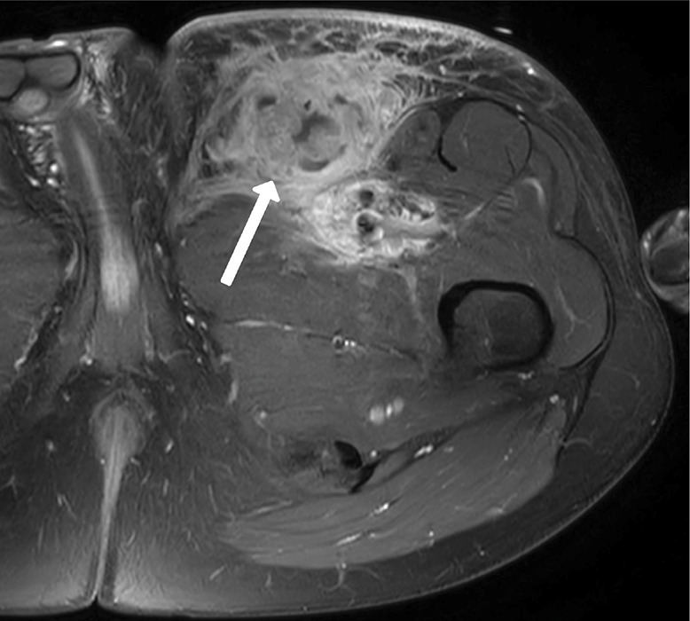 Kaposi Sarcoma: Almost Forgotten but Occasionally There.