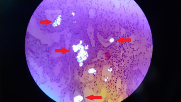 A case report of renal oxalosis and secondary hyperoxaluria due to chronic high vitamin C consumption.