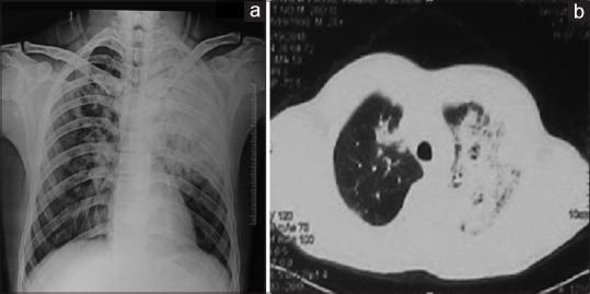 Radiological resolution of community-acquired pneumonia in hospitalised patients in North India.