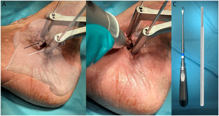 Minimally Invasive Cartilage Resection of the Subtalar Joint: An Anatomical Study.