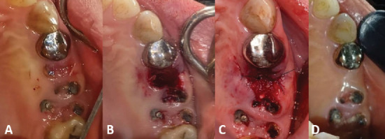 Alveolar Ridge Preservation Using a Mixture of Alb-PRF and Alloplastic Bone Graft: A Case Report.