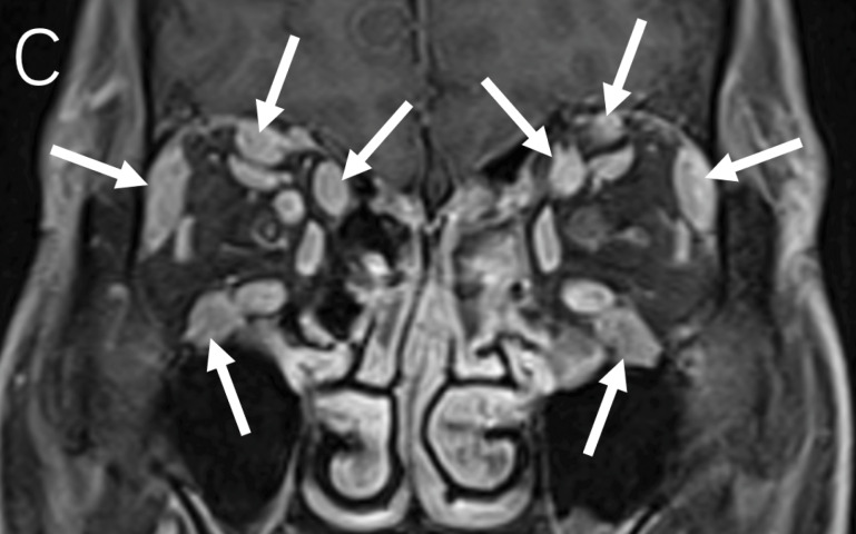 Extensive Involvement of the Bilateral Trigeminal Nerve Branch as the Only Imaging Manifestation of IgG4‑Related Ophthalmic Disease.