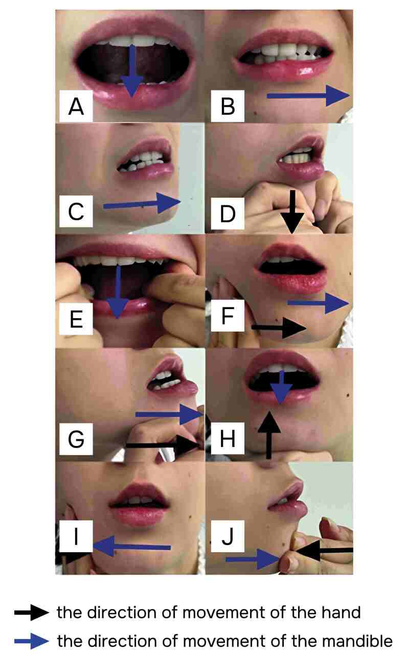 Does infection of a mandibular fracture lead to the development of chronic pain syndrome? Assessment of patient treatment results based on functional indicators, standardized questionnaires and quality of life assessment.