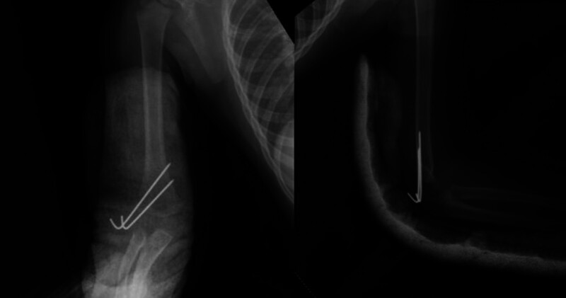 Comparison of radiological, clinical, and functional results of Jakob type 2 lateral condyle fractures treated with closed reduction and percutaneous pinning versus open reduction and K-wire fixation.