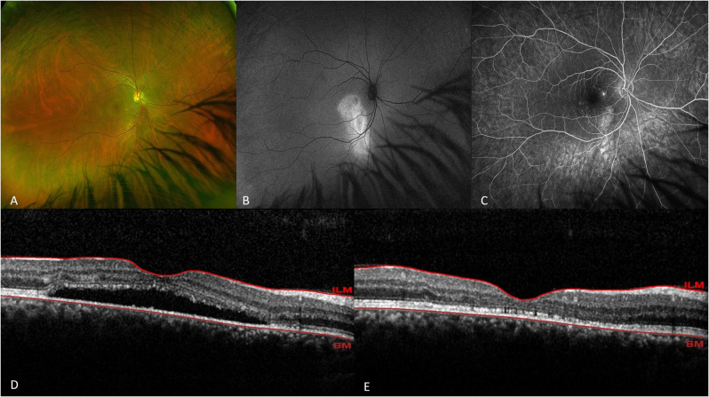 Comparative efficacy of half-dose and one-third-dose photodynamic therapy in chronic central serous chorioretinopathy: a retrospective study.