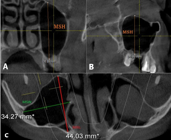 Anatomical and Pathological Assessment of the Maxillary Sinus Using CBCT Imaging: A Retrospective Descriptive Study.