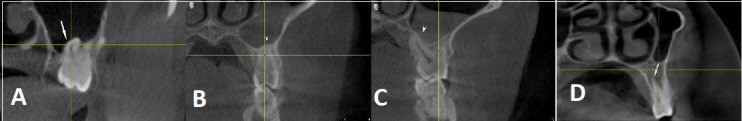 Anatomical and Pathological Assessment of the Maxillary Sinus Using CBCT Imaging: A Retrospective Descriptive Study.