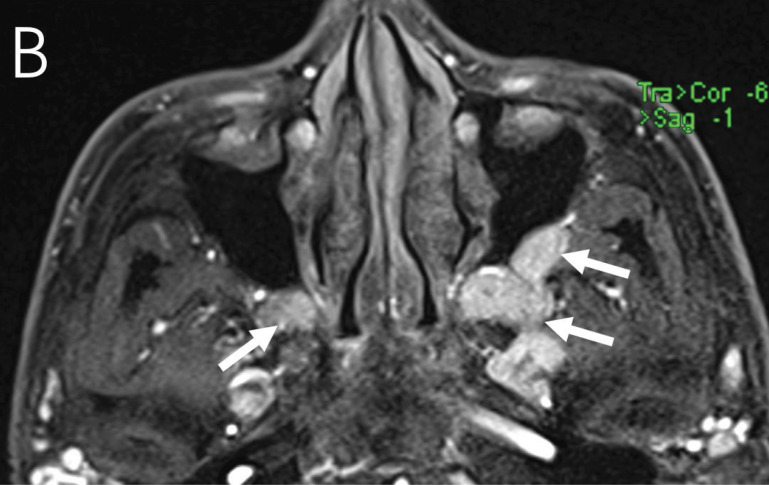 Extensive Involvement of the Bilateral Trigeminal Nerve Branch as the Only Imaging Manifestation of IgG4‑Related Ophthalmic Disease.