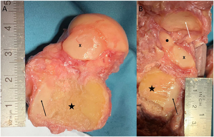 Minimally Invasive Cartilage Resection of the Subtalar Joint: An Anatomical Study.