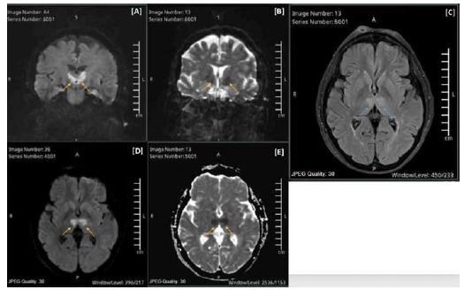 Acute artery of Percheron stroke: To treat or retreat with thrombolysis?