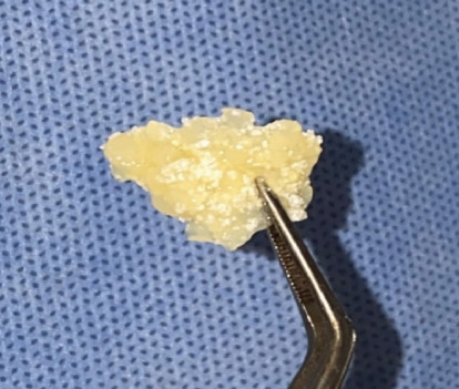 Alveolar Ridge Preservation Using a Mixture of Alb-PRF and Alloplastic Bone Graft: A Case Report.