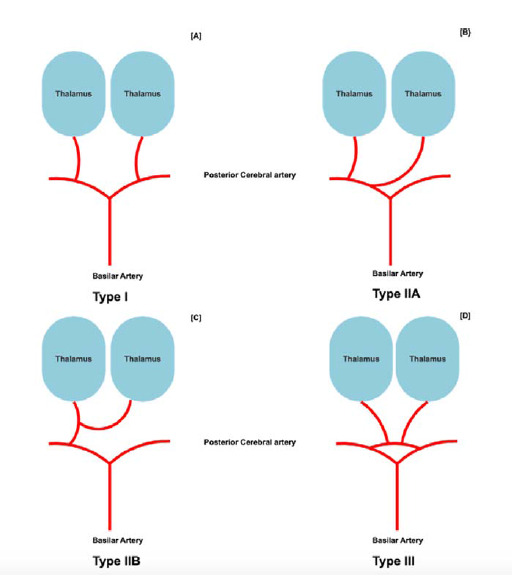 Acute artery of Percheron stroke: To treat or retreat with thrombolysis?