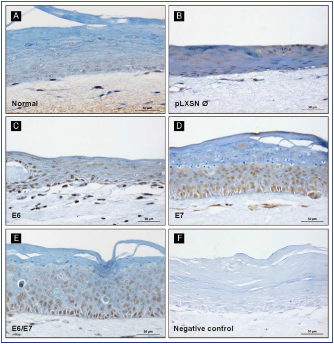 Gastrin-releasing peptide receptor: a promising new biomarker to identify cervical precursor lesions and cancer.