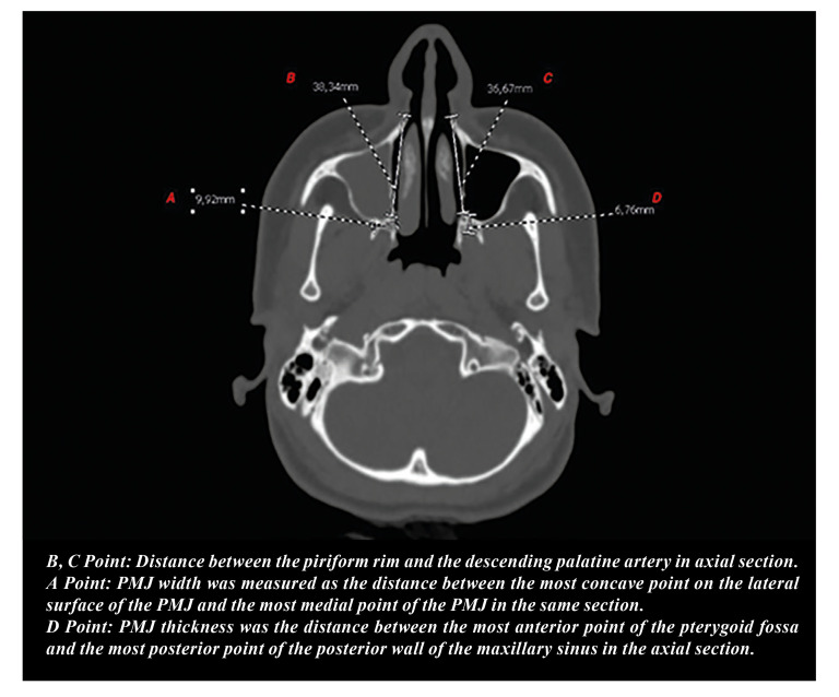 What is the impact of lateral nasal wall osteotomy depth on pterygomaxillary separation during a Le Fort I downfracture?