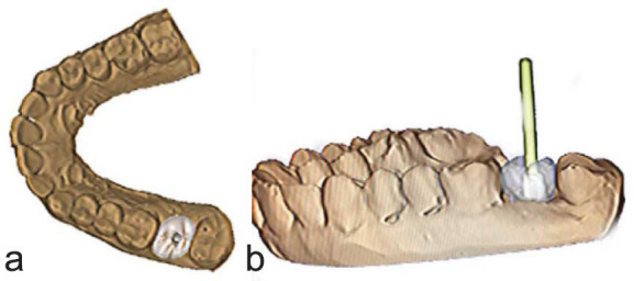 A Novel Technique to Retrieve Cement Retained Implant Supported Prosthesis with Digital Imaging: A Technical Report.