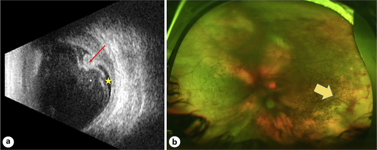 Bilateral Vasoproliferative Tumors in Usher Syndrome.
