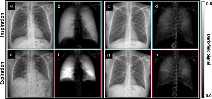 Dark-field chest radiography signal characteristics in inspiration and expiration in healthy and emphysematous subjects.