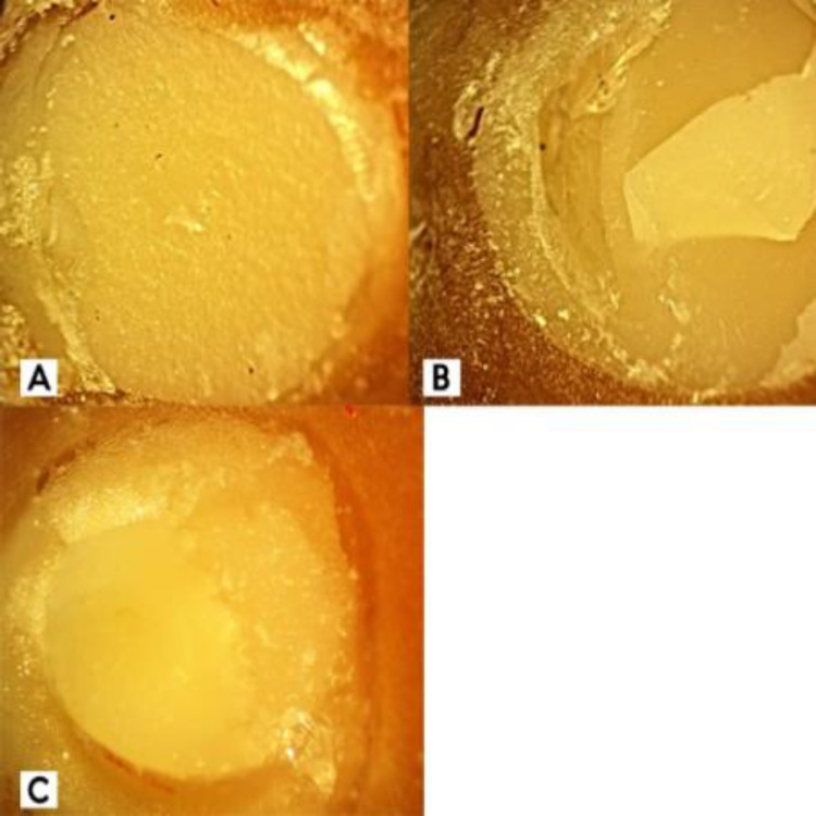 Effect of Er:YAG Laser Irradiation with Various Power Levels on Shear Bond Strength of Repair to Aged Nanofilled Composite Resin.