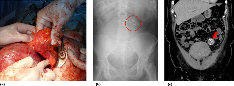 Efforts to prevent surgical sponge retention: check X-ray on the big screen.
