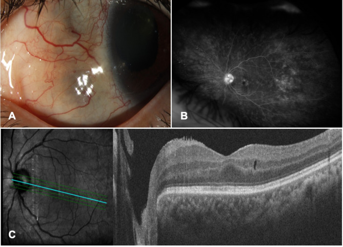 Presumed granulomatosis with polyangiitis presenting with anterior scleritis and inflammatory ciliary body granuloma.