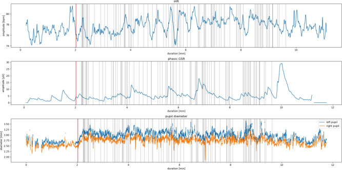 Assessment of PTSD in military personnel via machine learning based on physiological habituation in a virtual immersive environment.