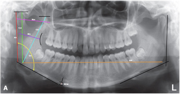 The influence of age, sex, and mandibular morphometric parameters on cortical bone width and erosion: a panoramic radiography study.