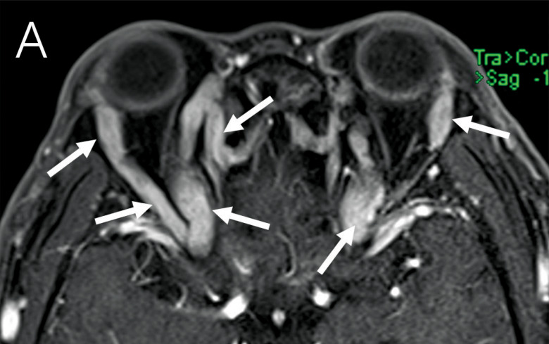 Extensive Involvement of the Bilateral Trigeminal Nerve Branch as the Only Imaging Manifestation of IgG4‑Related Ophthalmic Disease.