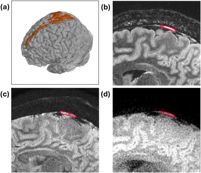 MUSE and PROPELLER DWI for ADC in parasagittal dura: insights from high-resolution and reduced-distortion DWI.