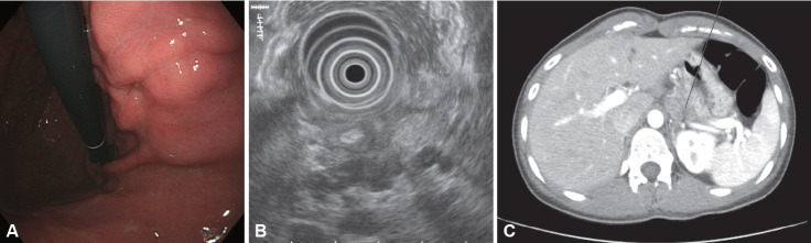 Gastric Ulcers Caused by Non-Helicobacter pylori Infections.