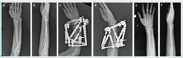 Computer-Assisted Circular External Fixator in the Treatment of Wrist and Forearm Deformities: Functional and Radiological Outcomes.
