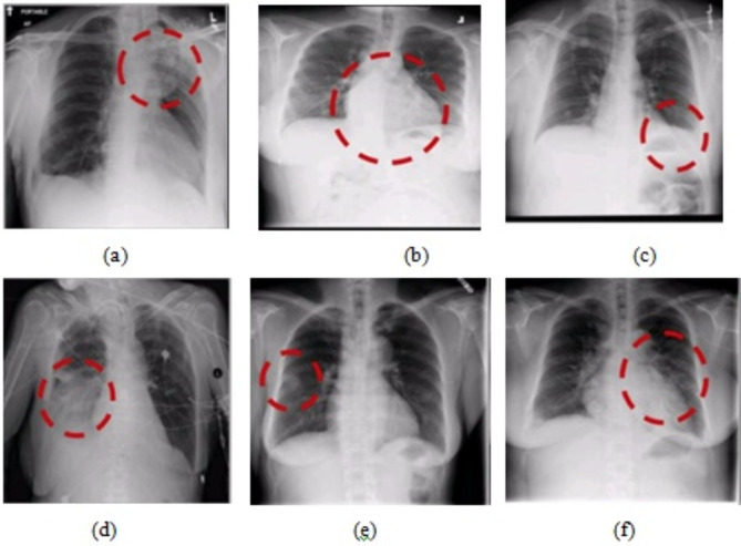 Lung cancer detection with machine learning classifiers with multi-attribute decision-making system and deep learning model.