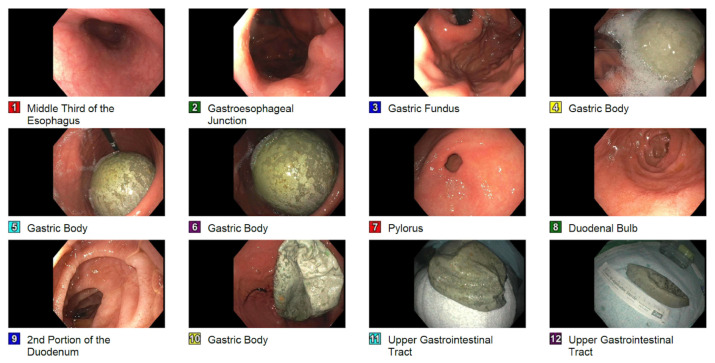 Rare Case of Intragastric Balloon Induced Acute Pancreatitis.