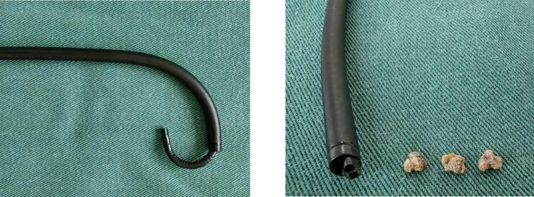 Analysis of the effectiveness and safety of 7.5 Fr ultra-thin flexible ureteroscope combined with a tip-flexible suctioning ureteral access sheath for the treatment of kidney stones.