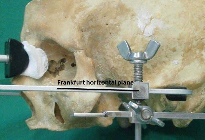Articular Eminence Inclination between Croatian and American Skulls.