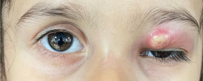 Invasive bony destructive orbital aspergillosis in an immunocompetent child: a case report.