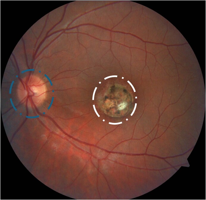 The importance of translational research in the study of ocular toxoplasmosis: insights from the 17th International Congress on Toxoplasmosis 2024.