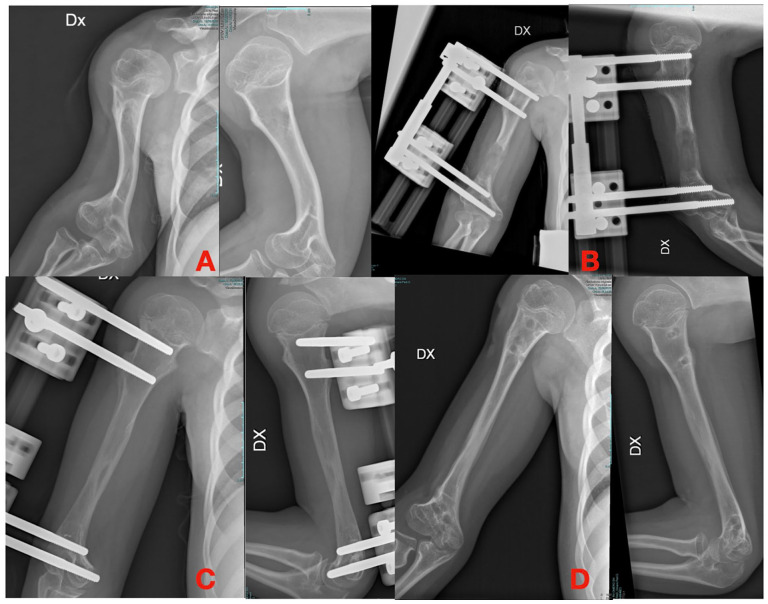 External fixators and lengthening systems in pediatric upper limb.